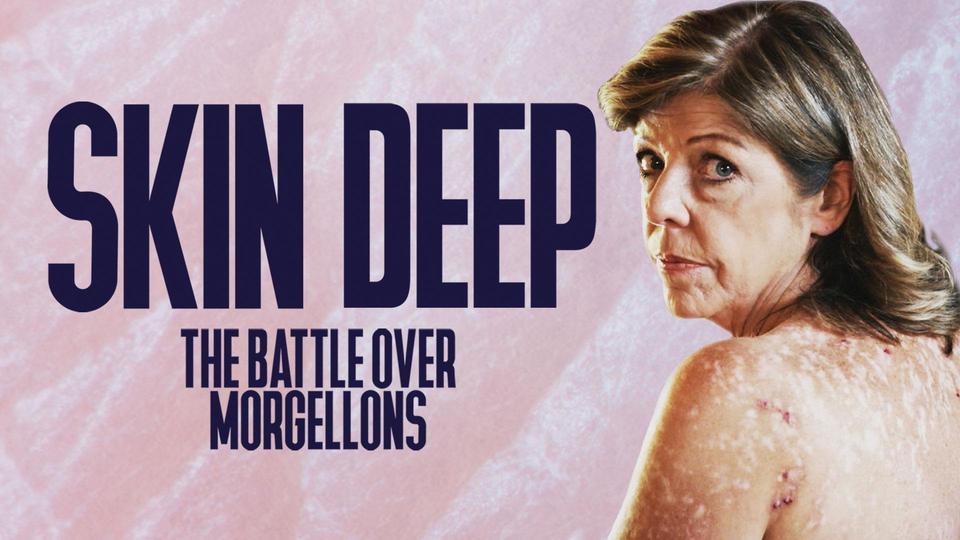 その他 Skin Deep: The Battle Over Morgellons [DVD] Skin Deep: The Battle Over Morgellons | Kanopy